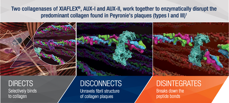 Two collagenases of XIAFLEX®, Aux I and Aux II, work together to enzymatically disrupt the predominant collagen found in Peyronie's plaques types 1 and 3 (1)