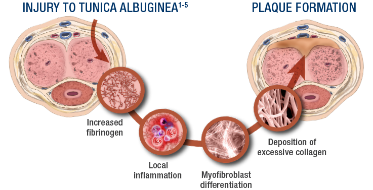 An illustration showing the path from injury to tunica albuginea (1 - 5) to plaque formation