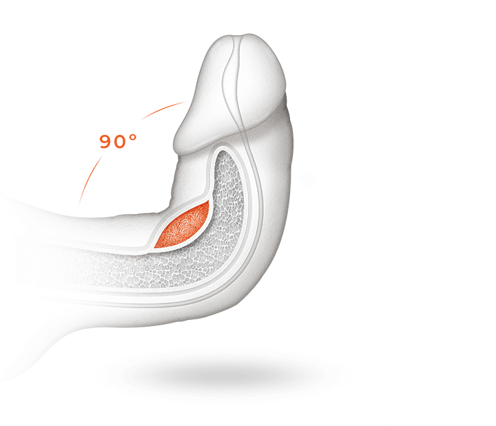 Curved penis from Peyronie’s disease with a 90-degree curve