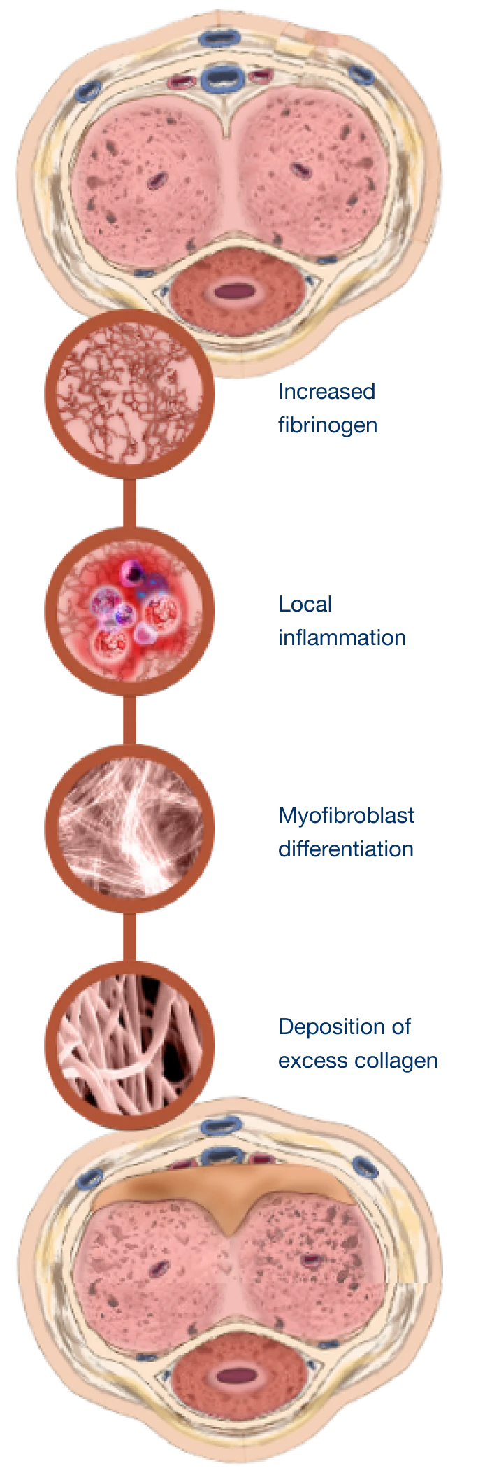 Internal view of injury to the tunica albuginea and palpable Peyronie’s plaque formation