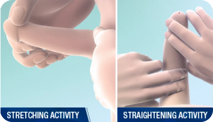 A graphic demonstrating the patient’s at-home penile remodeling procedure: the left depicts the stretching activity, while the right shows the straightening activity