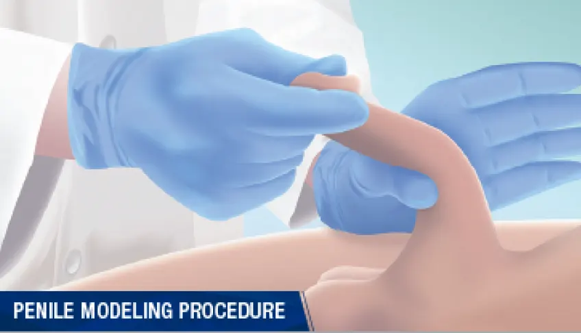 A graphic depicting the in-office penile remodeling process