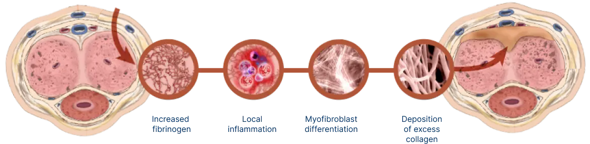 Internal view of injury to the tunica albuginea and palpable Peyronie’s plaque formation