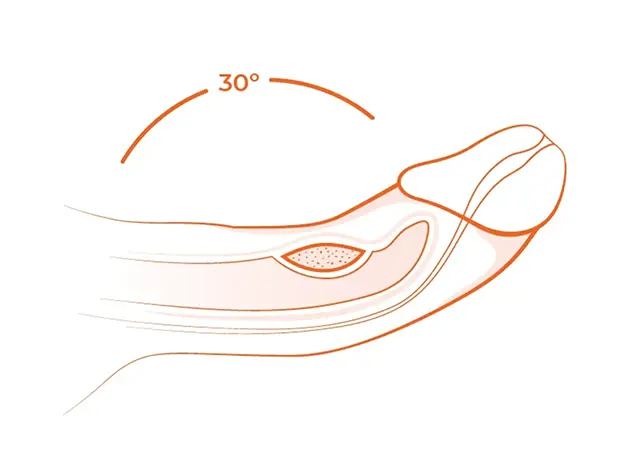 A depiction of a 30° degree erectile curvature