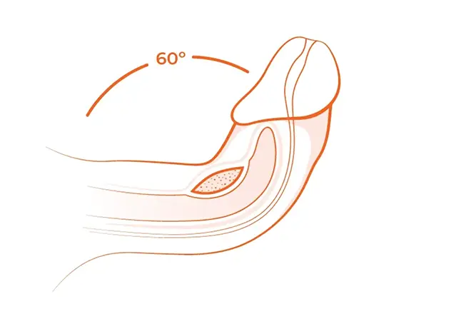 A depiction of a 60° degree erectile curvature