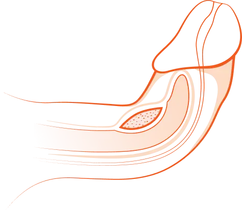 An illustration of an erect penis bending abnormally due to a buildup of plaque