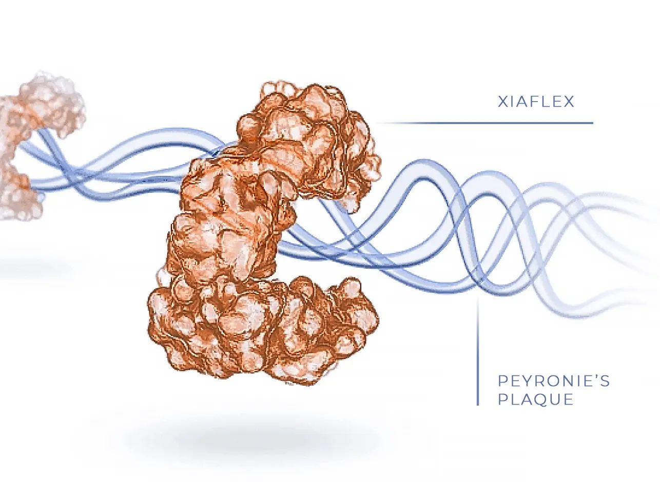 An illustration of XIAFLEX unwinding the complex fibers of the Peyronie’s plaque