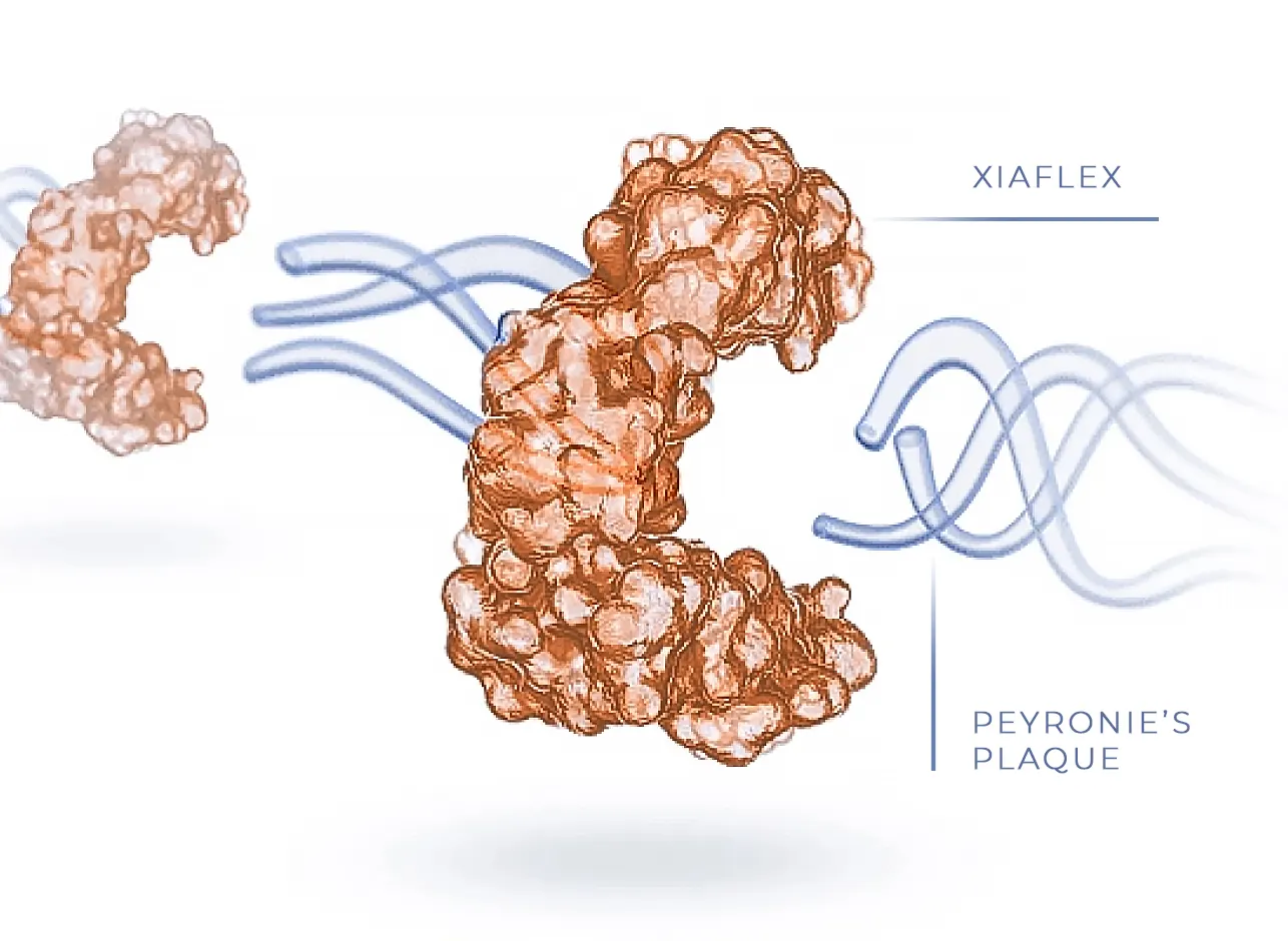 An illustration of XIAFLEX breaking down the bonds that hold the plaque together